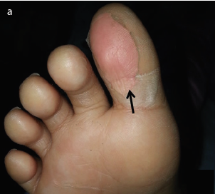 Periungual dryness without resultant desquamation in a child with kawasaki disease: A new clinical finding?
