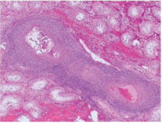 Isolated testicular vasculitis due to immune checkpoint inhibitor