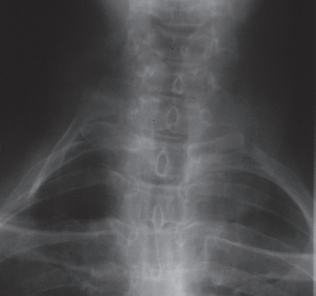 A cervical rib presenting as a hard, immobile lump in the neck