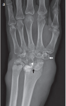 Tuberculosis monoarthritis of the wrist mimicking rheumatoid arthritis